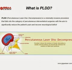 Kỹ thuật điều trị thoát vị đĩa đệm bằng laser qua da (PLDD) là gì?