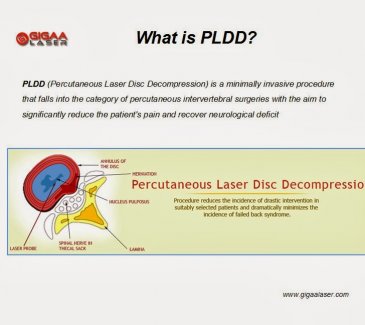 Kỹ thuật điều trị thoát vị đĩa đệm bằng laser qua da (PLDD) là gì?